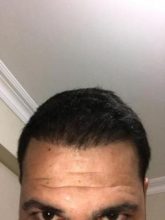 arenamed-hair-transplant-result (3)