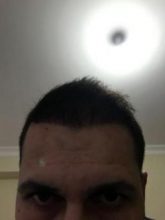 arenamed-hair-transplant-result (30)