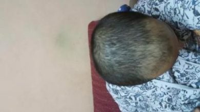 arenamed-hair-transplant-result (4)