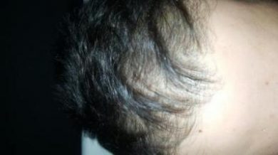 arenamed-hair-transplant-result (5)