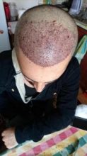 arenamed-hair-transplant-result (7)