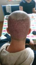 arenamed-hair-transplant-result (8)