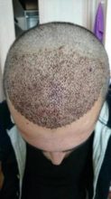 arenamed-hair-transplant-result (9)