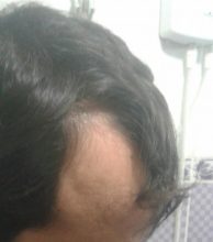 before-hair-transplant