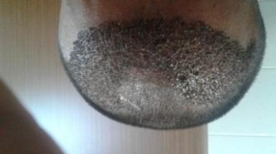 doctor-kul-hair-transplant (1)