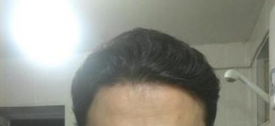 doctor-kul-hair-transplant (10)
