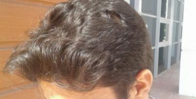 doctor-kul-hair-transplant (11)