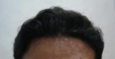 doctor-kul-hair-transplant (12)