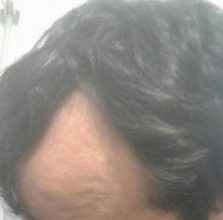 doctor-kul-hair-transplant (13)