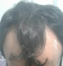 doctor-kul-hair-transplant (14)
