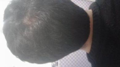 doctor-kul-hair-transplant (15)