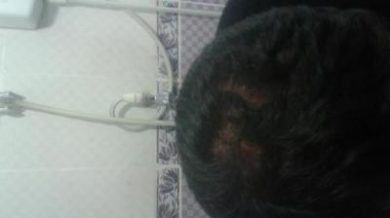 doctor-kul-hair-transplant (16)