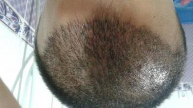 doctor-kul-hair-transplant (2)