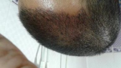 doctor-kul-hair-transplant (3)