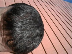 doctor-kul-hair-transplant (4)