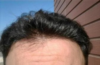 doctor-kul-hair-transplant (5)