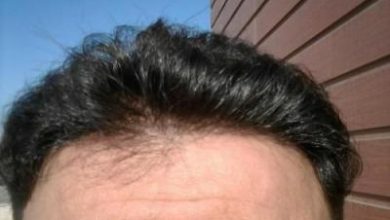 doctor-kul-hair-transplant (5)