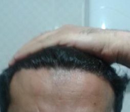 doctor-kul-hair-transplant (6)