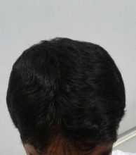 doctor-kul-hair-transplant (7)