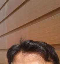 doctor-kul-hair-transplant (8)