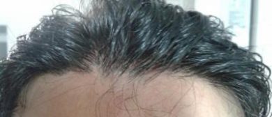 doctor-kul-hair-transplant (9)