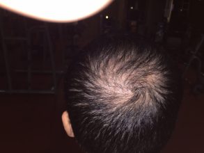 dr-cinik-hair-transplant-results (1)