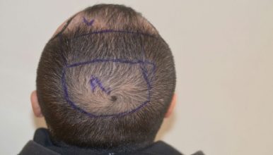 dr-cinik-hair-transplant-results (10)