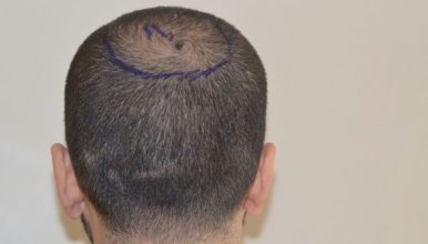 dr-cinik-hair-transplant-results (11)