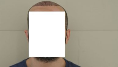 dr-cinik-hair-transplant-results (12)