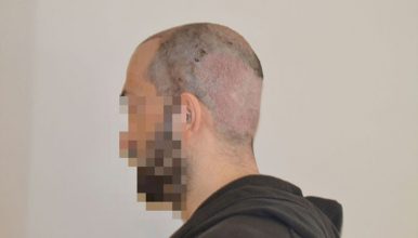 dr-cinik-hair-transplant-results (13)