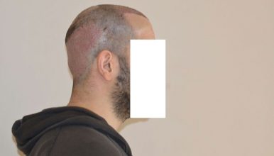 dr-cinik-hair-transplant-results (14)