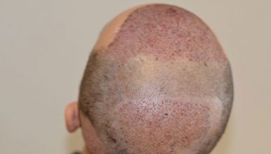 dr-cinik-hair-transplant-results (15)