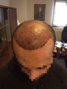 dr-cinik-hair-transplant-results (17)