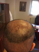 dr-cinik-hair-transplant-results (19)