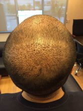 dr-cinik-hair-transplant-results (20)