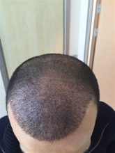 dr-cinik-hair-transplant-results (21)