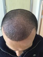 dr-cinik-hair-transplant-results (22)