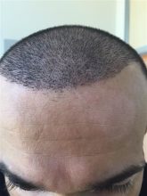 dr-cinik-hair-transplant-results (23)