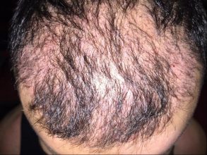 dr-cinik-hair-transplant-results (26)
