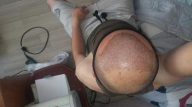 dr-cinik-hair-transplant-results (27)