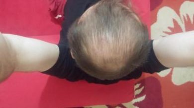 dr-cinik-hair-transplant-results (28)