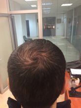 dr-cinik-hair-transplant-results (3)