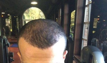 dr-cinik-hair-transplant-results (5)