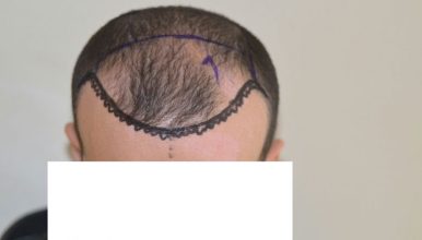 dr-cinik-hair-transplant-results (6)