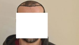 dr-cinik-hair-transplant-results (7)
