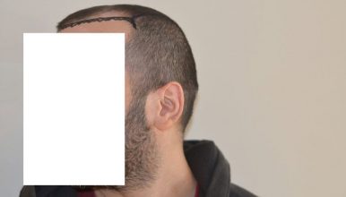 dr-cinik-hair-transplant-results (8)