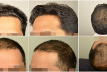 dr-erdogan-hair-transplant-result (1)