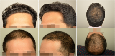 dr-erdogan-hair-transplant-result (1)