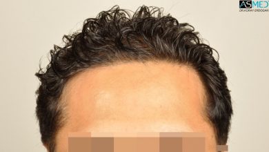 dr-erdogan-hair-transplant-result (1)