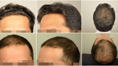 dr-erdogan-hair-transplant-result (1)